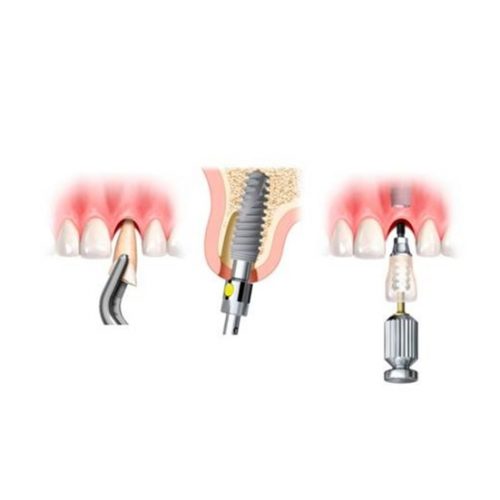 Implantes inmediatos