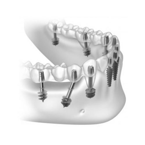 implantes-290x300-2-500x500