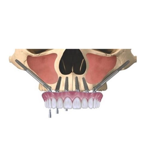 implantes-cigomaticos