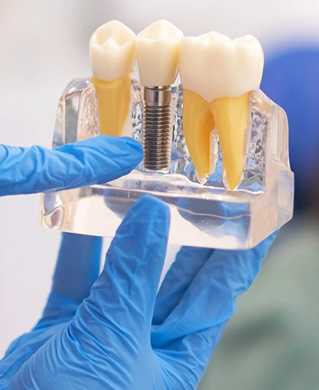 implantes en Arturo Soria destacado
