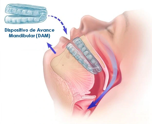apnea de sueno tratamiento