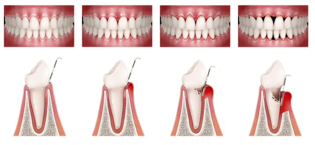 periodontitis en Arturo Soria