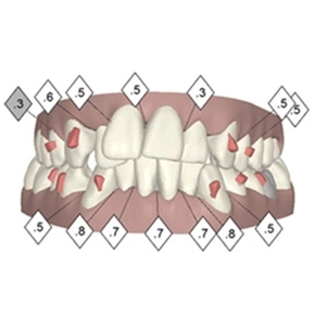 tratamiento invisalign